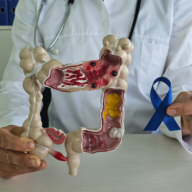 Colorectal Cancer