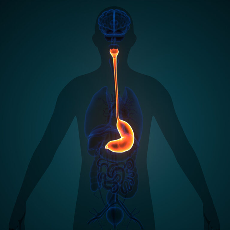 Esophageal Cance