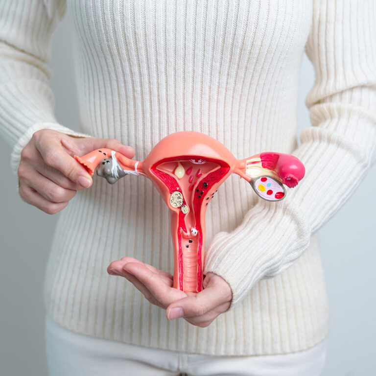Ovarian Cance